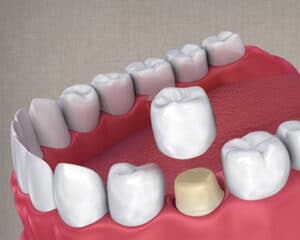 Custom color-matched dental crowns
